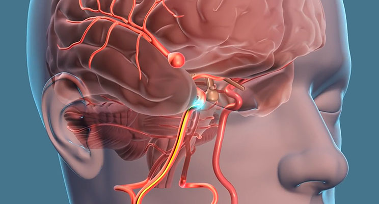 Brain Aneurysm Treatment India
