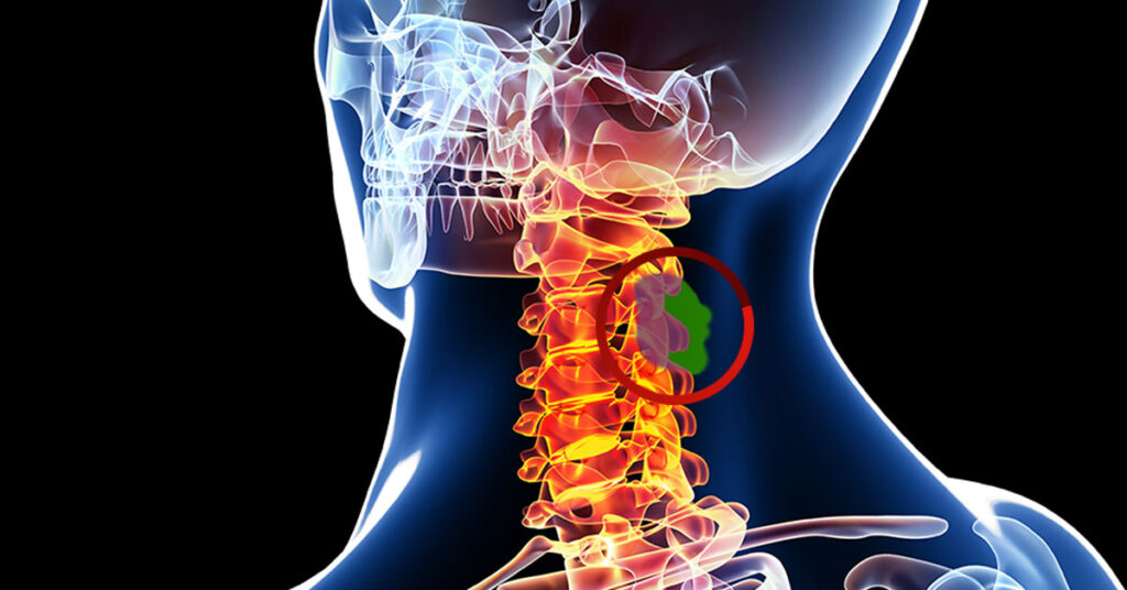 Cervical Spine Tumor Symptoms
