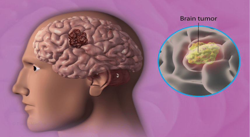 Brain Cancer Treatment